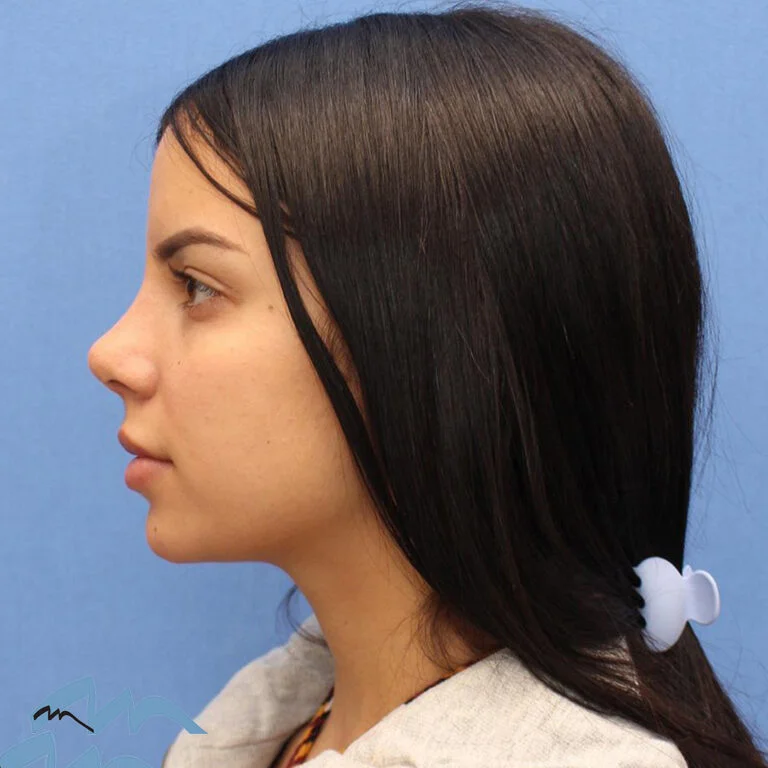 Rhinoplasty patient, front view, after