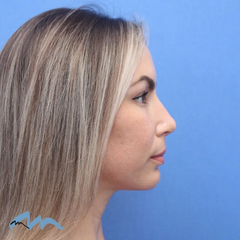Rhinoplasty patient, front view, after