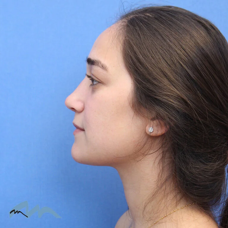 Rhinoplasty patient, front view, after