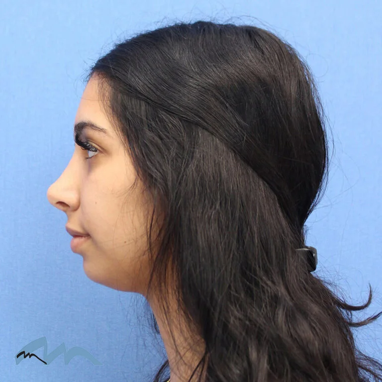 Rhinoplasty patient, three months post-op