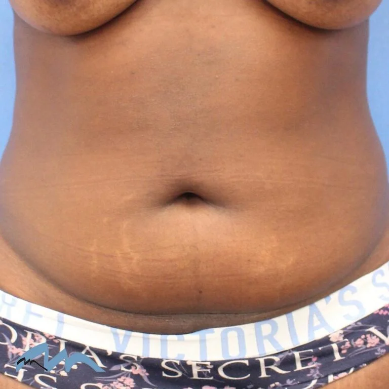 Liposuction patient, before