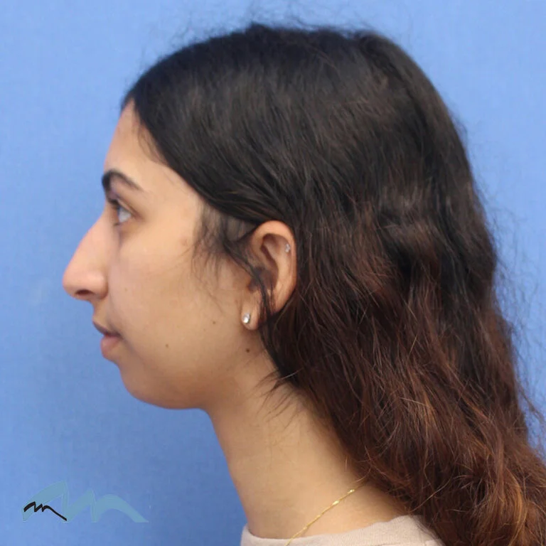 Rhinoplasty patient, before