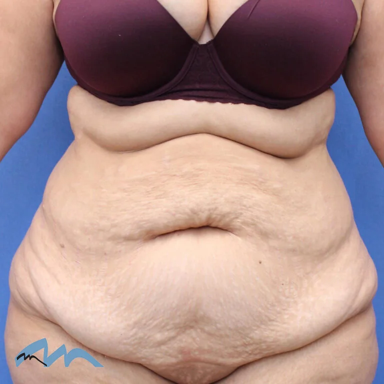 Tummy tuck patient, before
