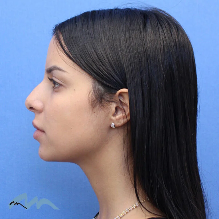 Rhinoplasty patient, front view, before